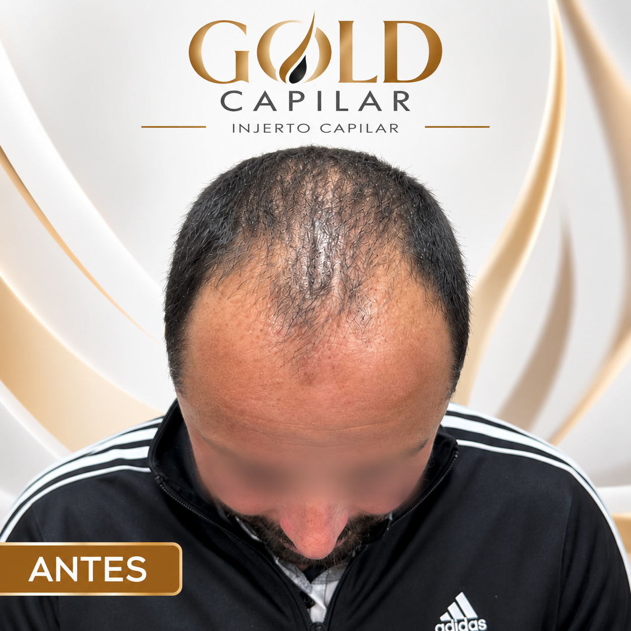 Antes del injerto capilar