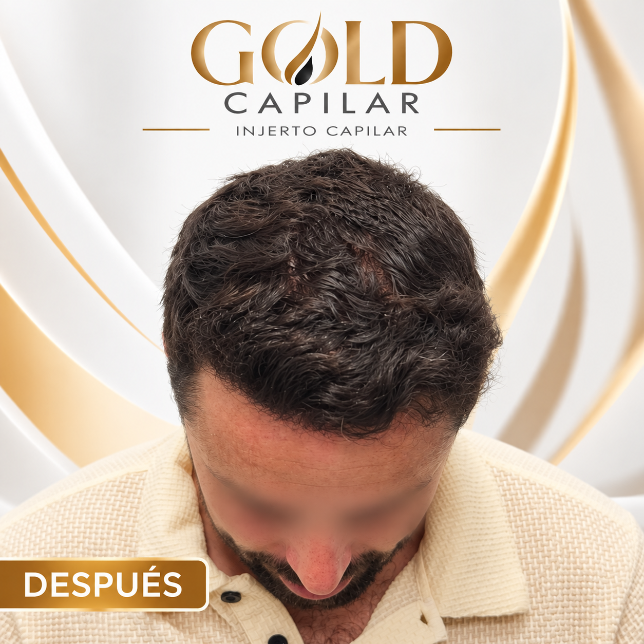Después del injerto capilar