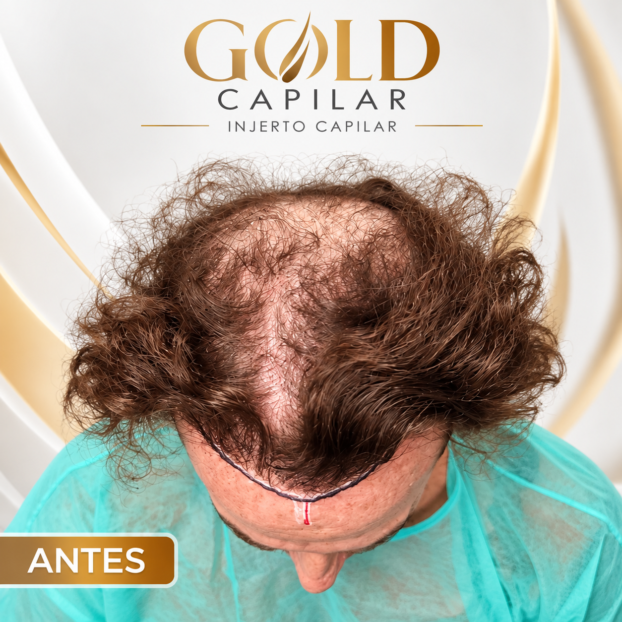 Antes del injerto capilar