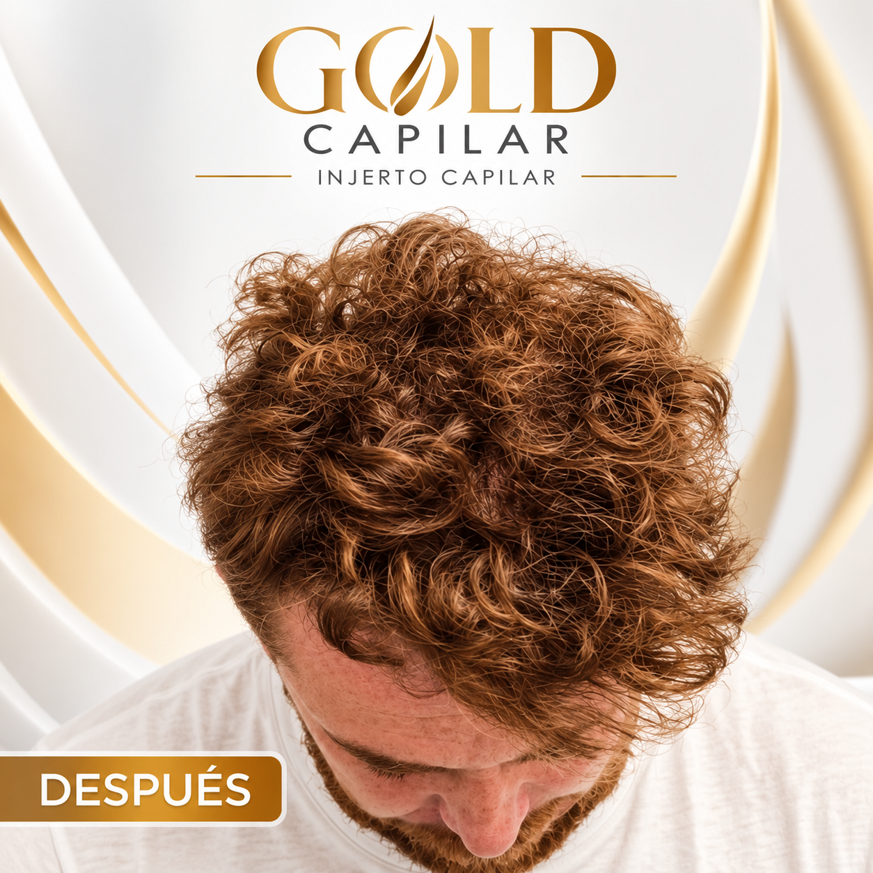 Después del injerto capilar