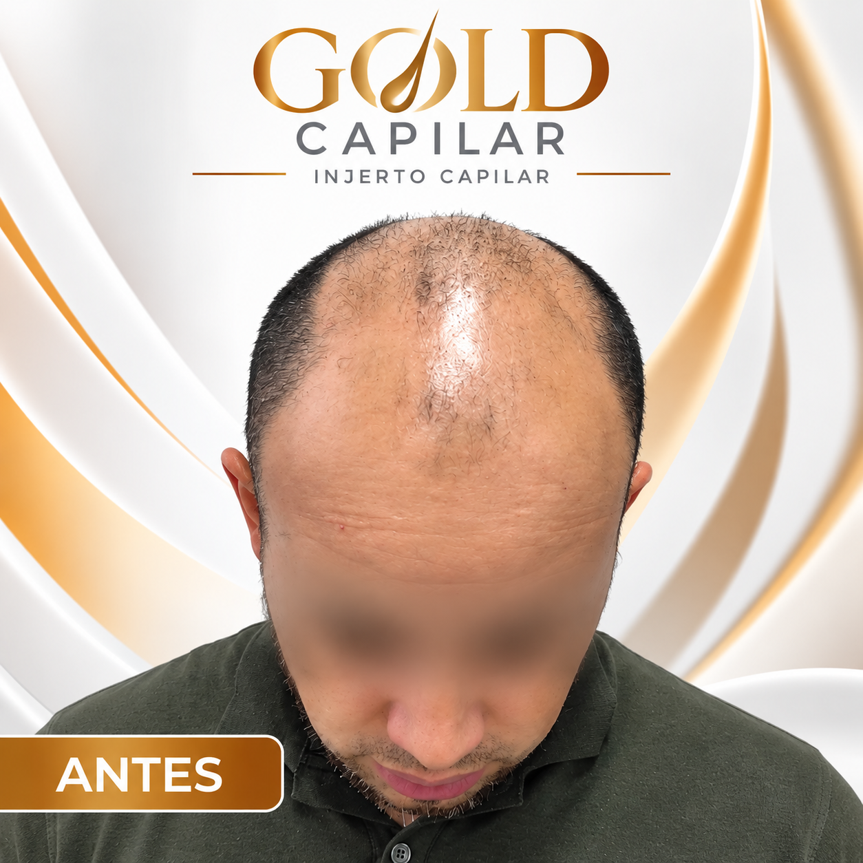 Antes del injerto capilar