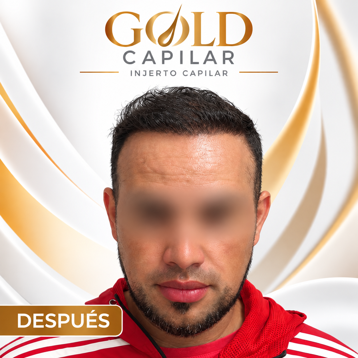 Después del injerto capilar