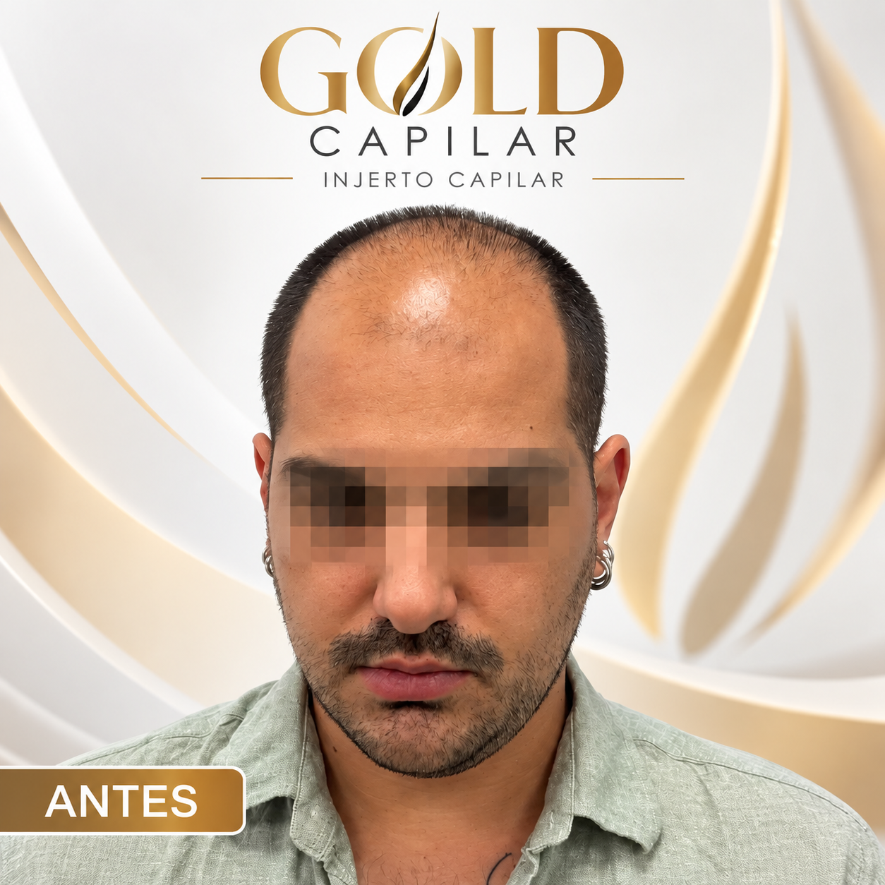 Antes del injerto capilar