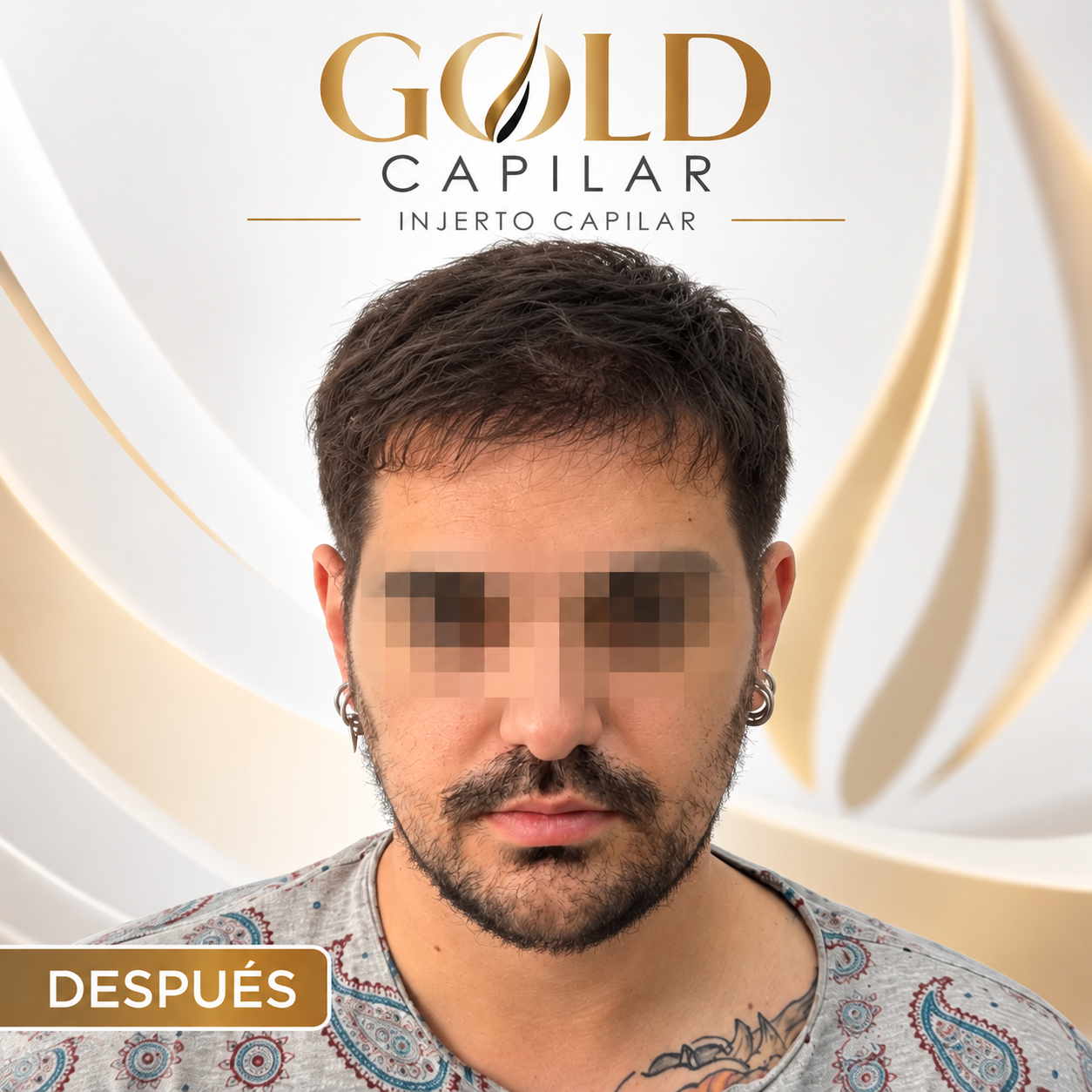 Después del injerto capilar