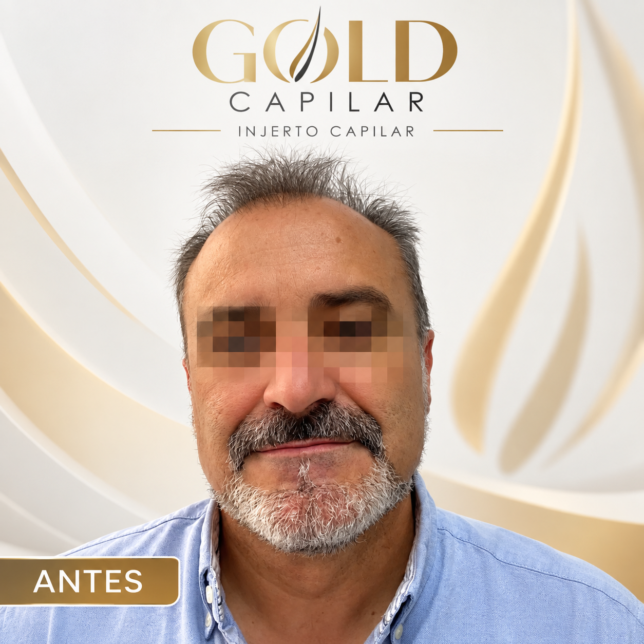 Antes del injerto capilar