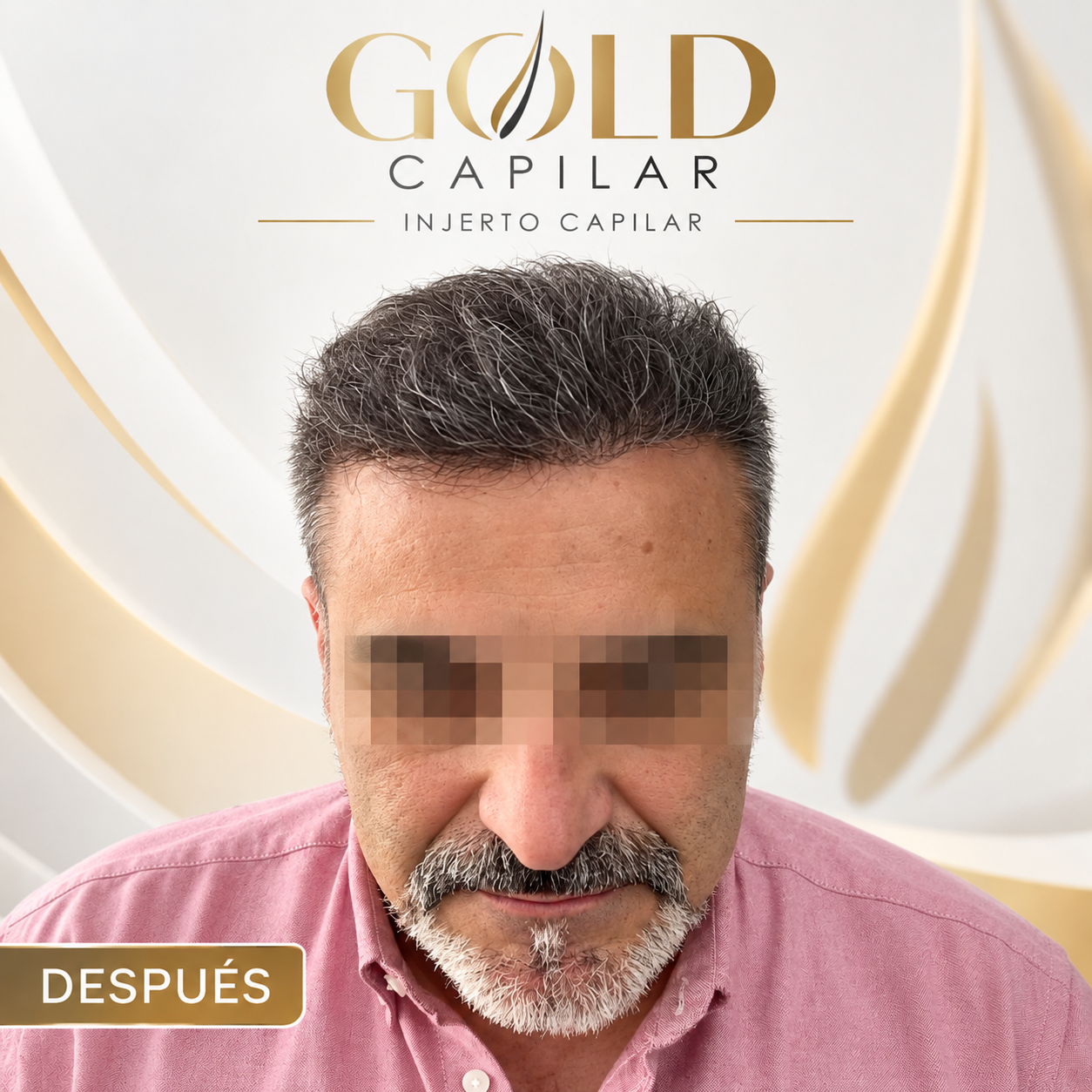 Después del injerto capilar