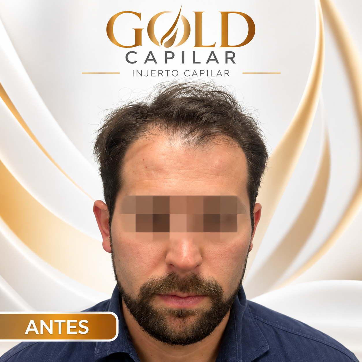 Antes del injerto capilar