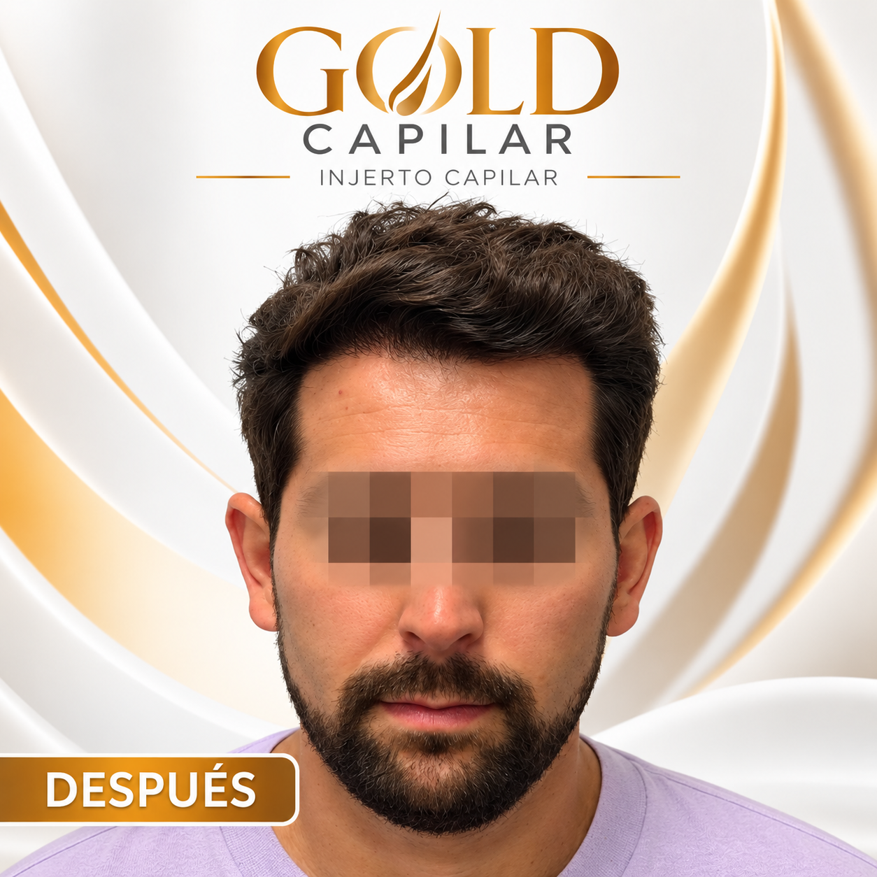 Después del injerto capilar