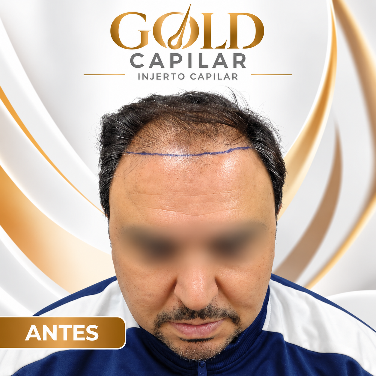 Antes del injerto capilar