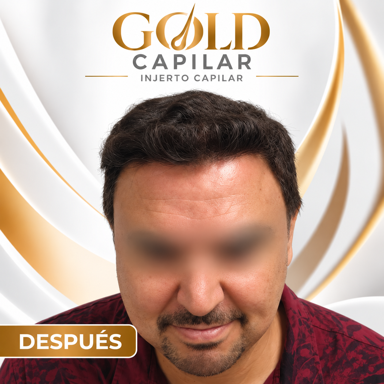 Después del injerto capilar
