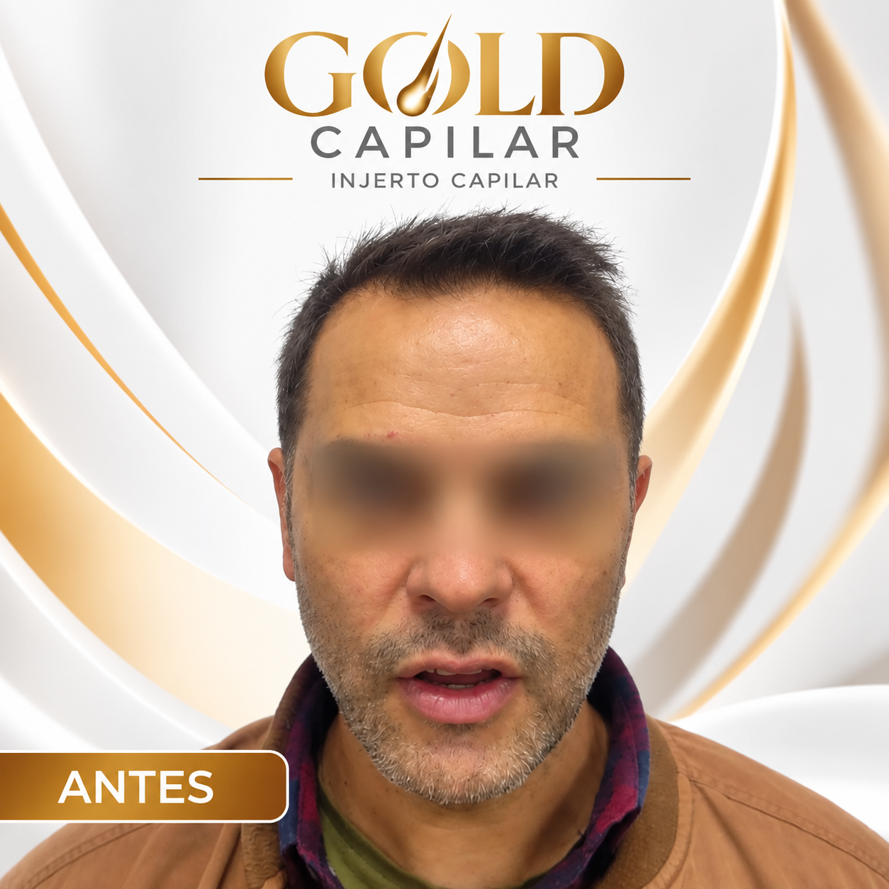 Antes del injerto capilar