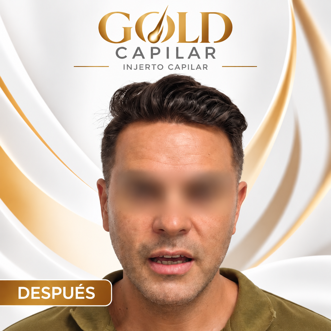 Después del injerto capilar